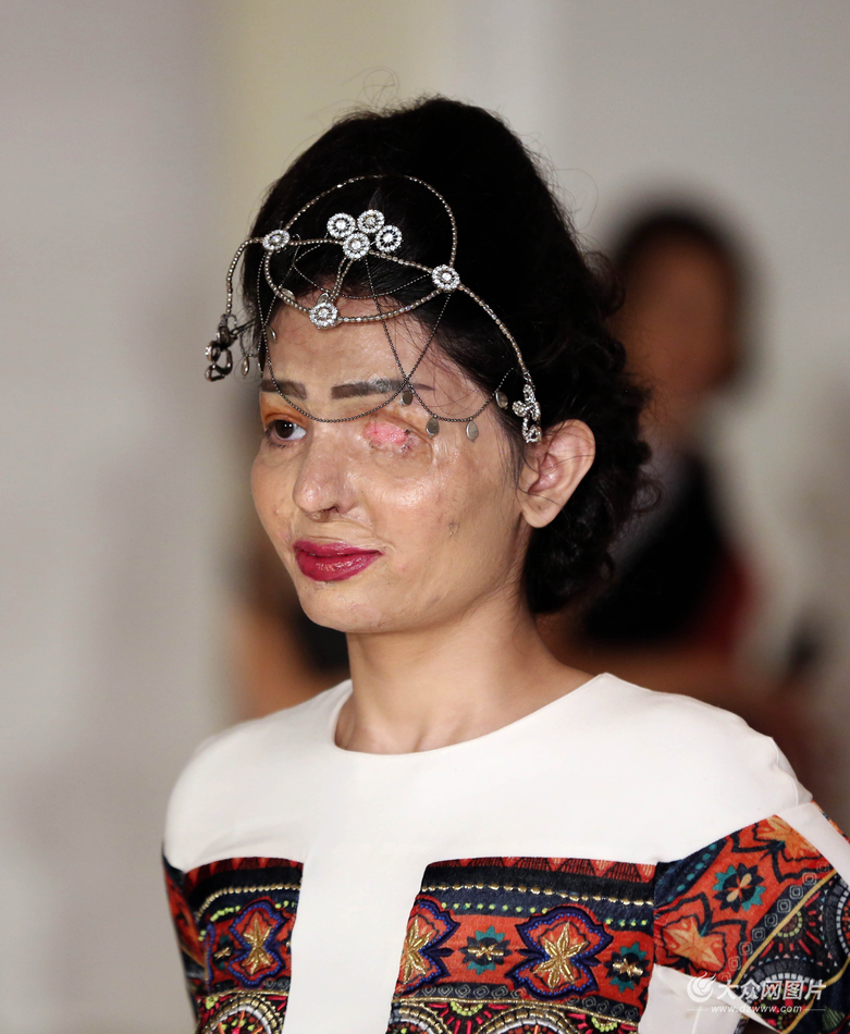印度被毁容女生走上纽约时装周 曾被泼硫酸失去一只眼睛