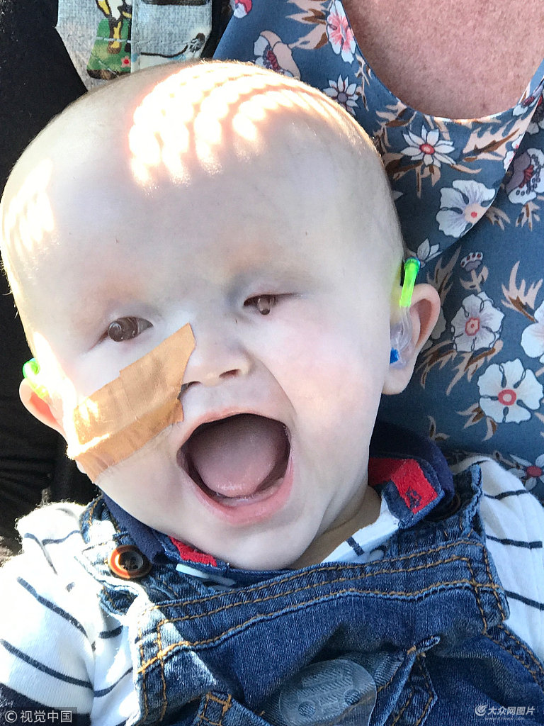 澳大利亚男婴患罕见遗传疾病出生时没有眼睛